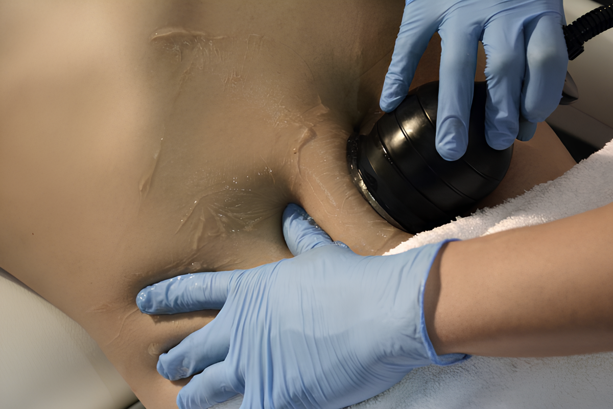 Illustration Cavitation